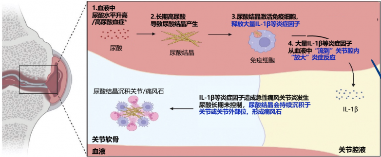 痛风新疗法