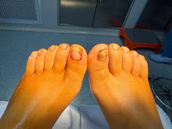 阻生性甲医学示意图