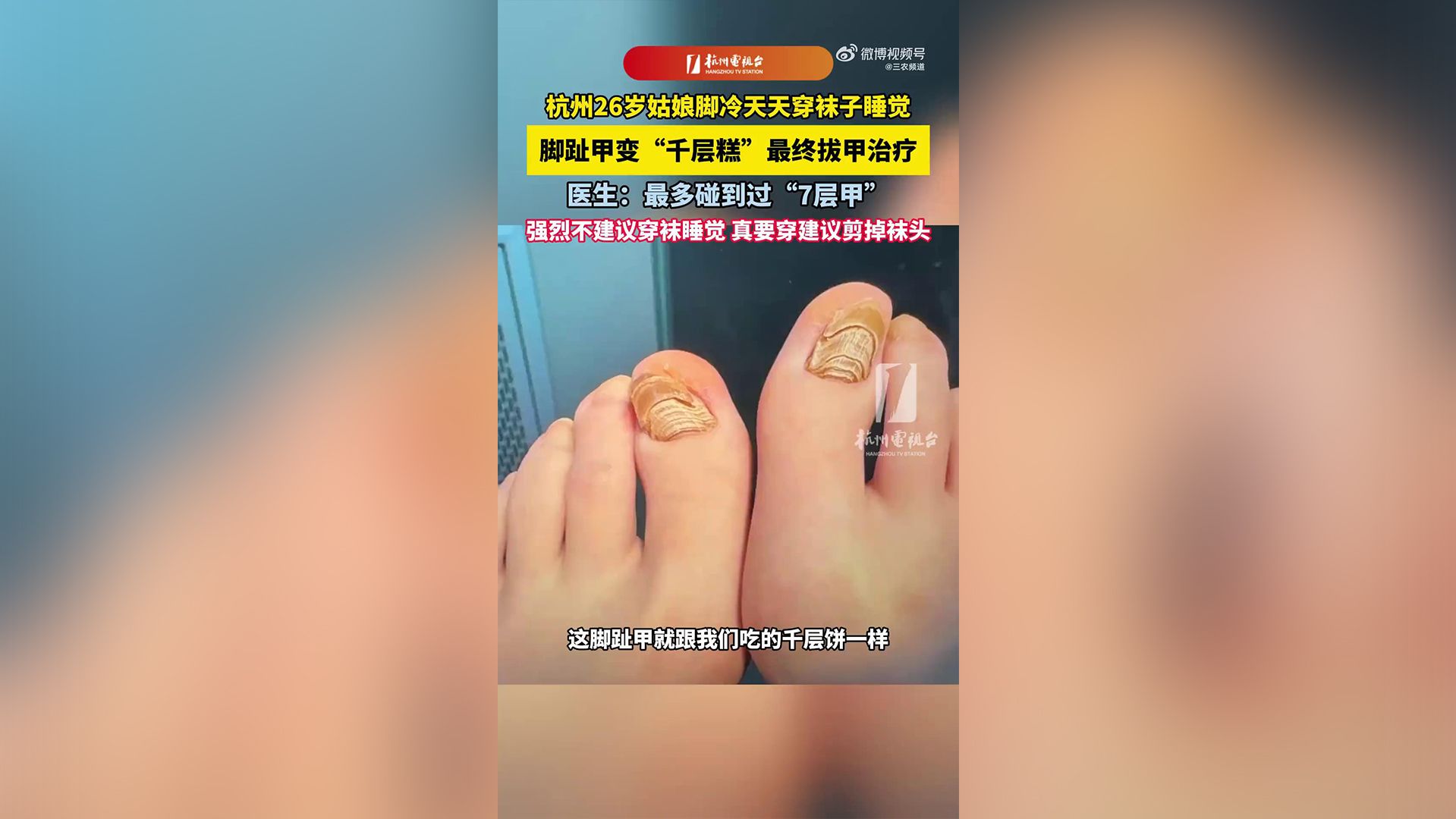 穿袜睡觉导致千层甲